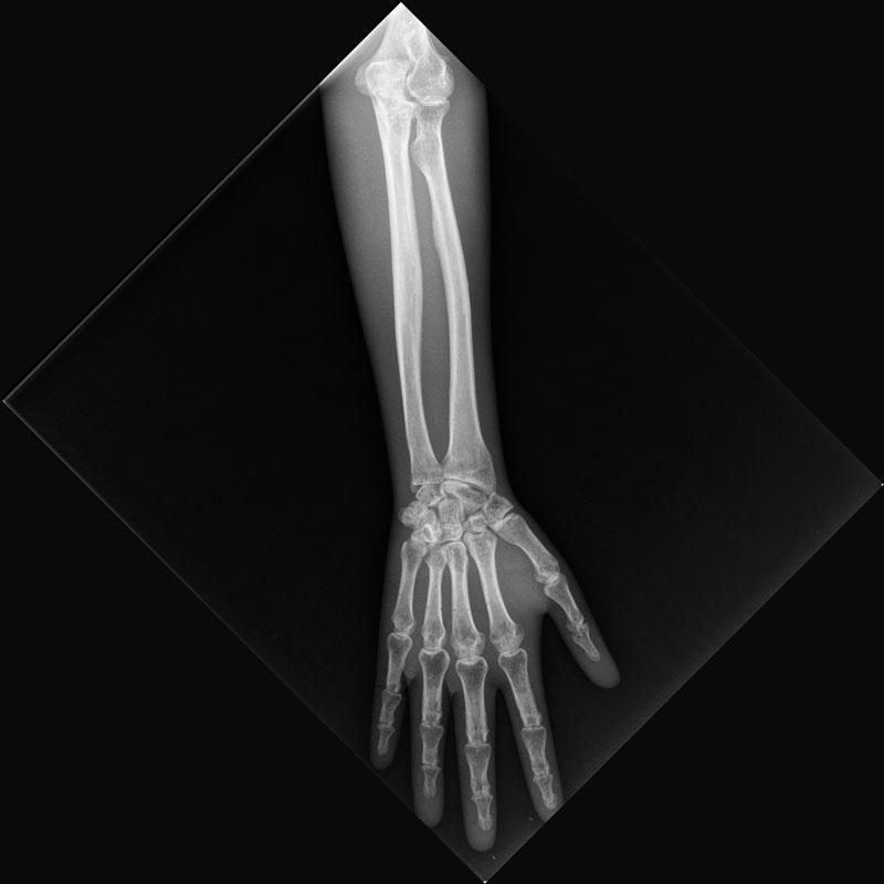 X-Ray Lower Arm Phantom, opaque