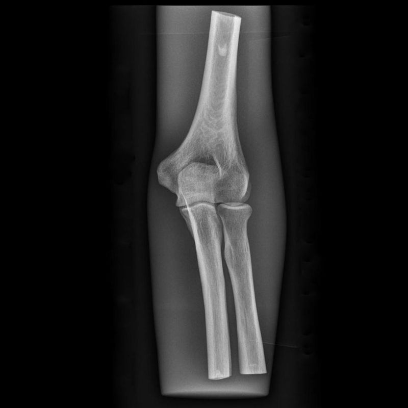 X-Ray Phantom Elbow, Transparent