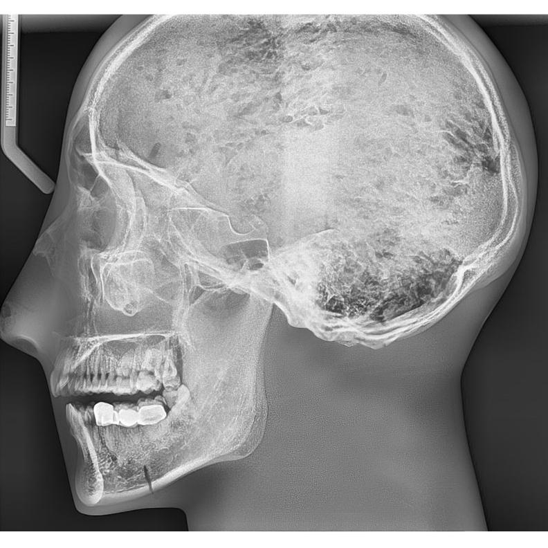 X-Ray Phantom Head, Opaque