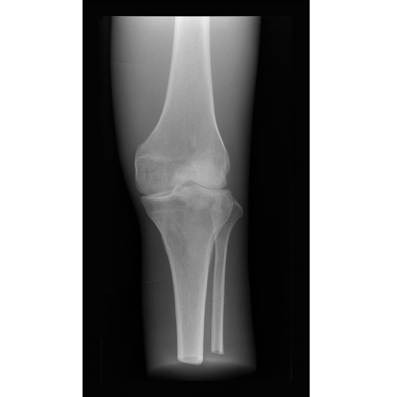 X-Ray Phantom Knee, Transparent